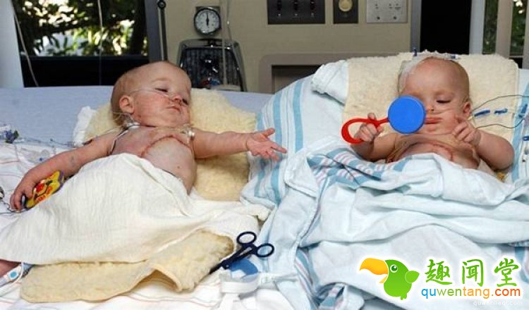 世界最罕见的连体婴，长大分开后的人生是这样