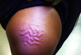 可怕！比基尼辣妹躺沙滩遭“活虫钻体”