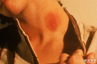 17岁健康青少年只是「被女友留下一个吻痕