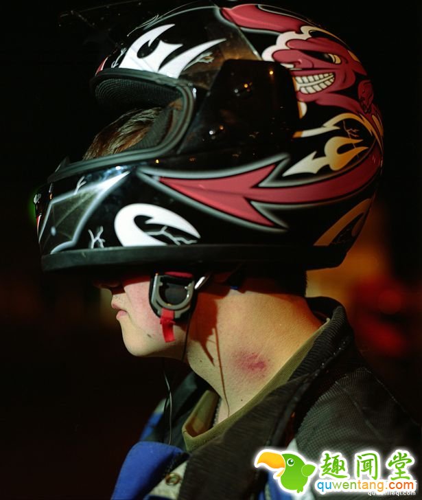 這名17歲健康青少年只是「被女友留下一個吻痕」，數小時後他就不幸喪命了...