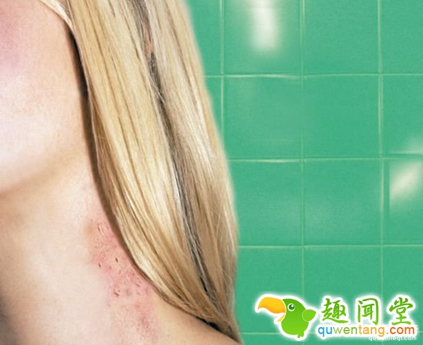 這名17歲健康青少年只是「被女友留下一個吻痕」，數小時後他就不幸喪命了...