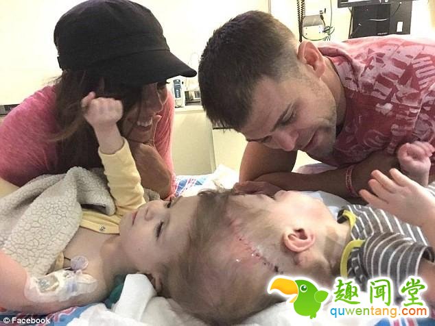 连体婴儿奇迹般存活！24小时的手术没有压倒美国这对双胞胎