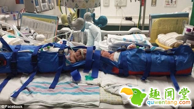 连体婴儿奇迹般存活！24小时的手术没有压倒美国这对双胞胎