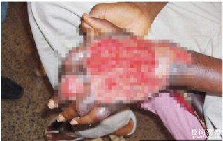 惊！澳洲爆发恐怖食肉菌疫情，蚊子咬到后