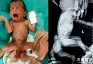 女婴出生4条腿 母亲：我很无助但没有放弃
