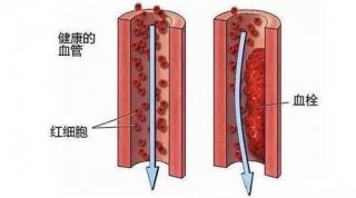清理血管，不用每年输液！食物里的清道夫
